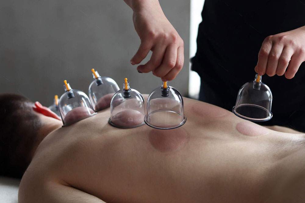 Cupping Therapy