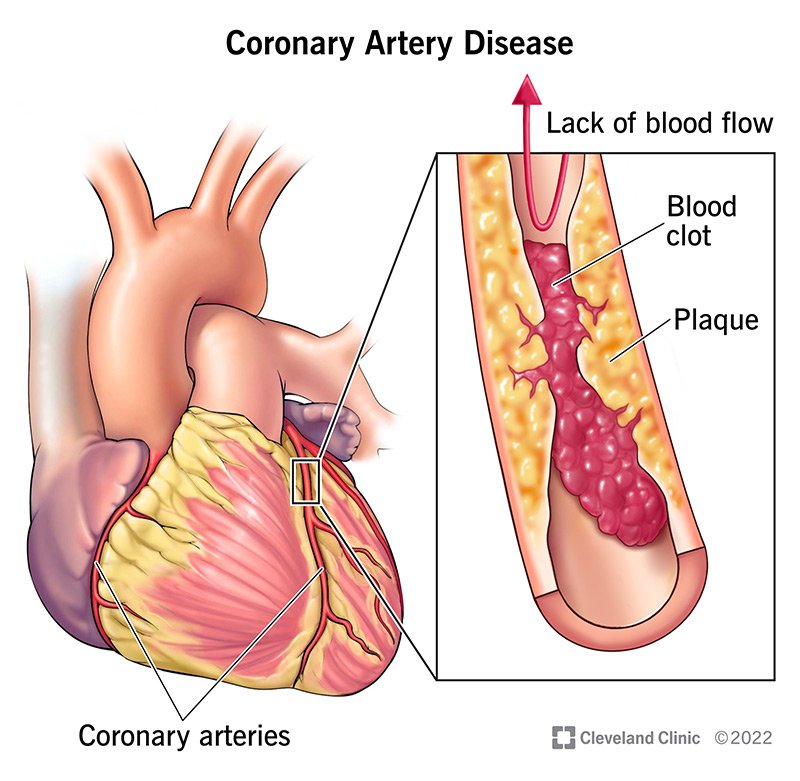 Ischemic Heart Disease (IHD)