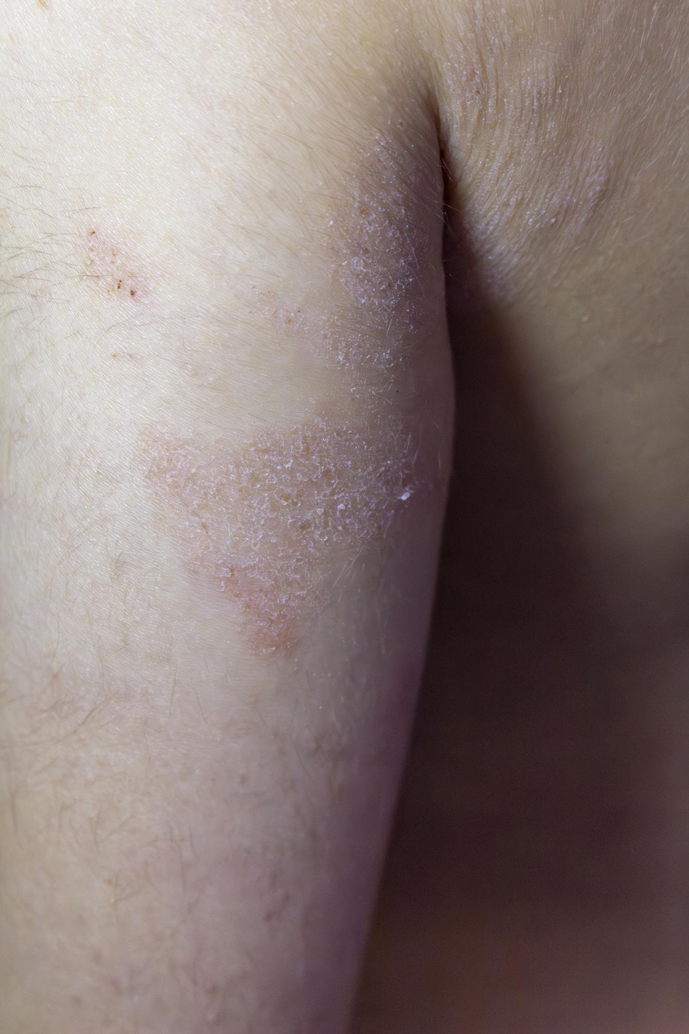 Eczema