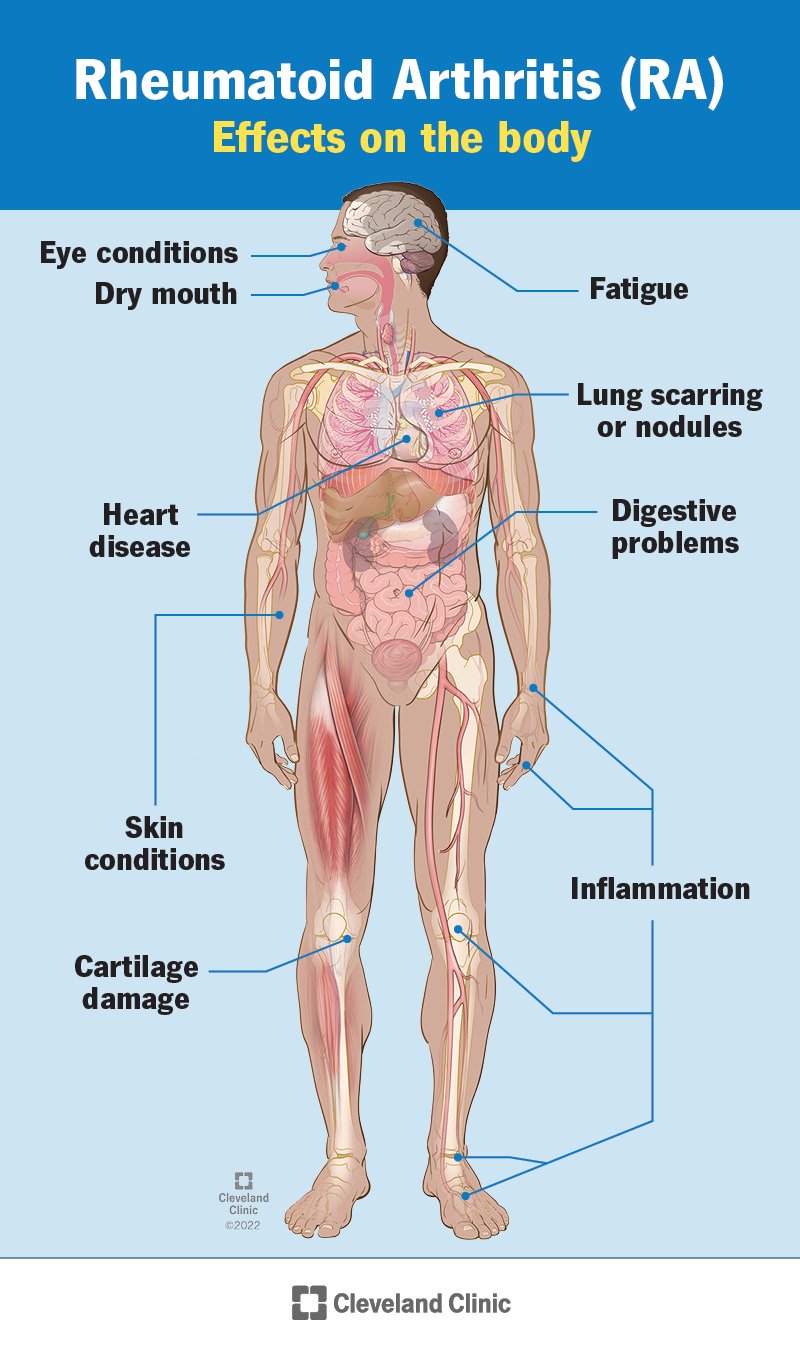 Rheumatoid arthritis