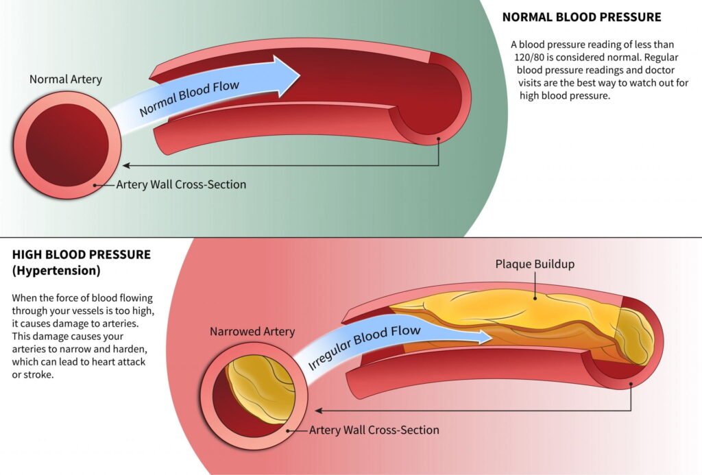 Erectile dysfunction (ED)