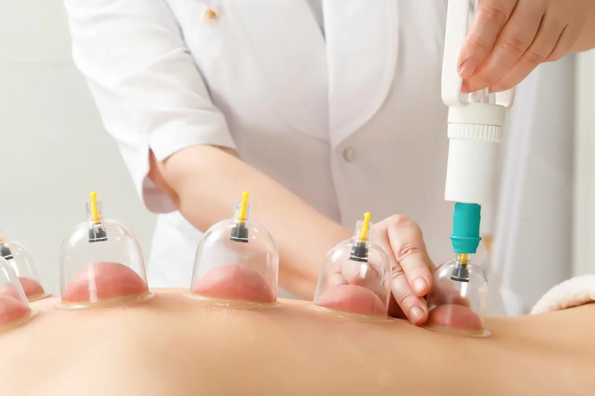 Cupping Therapy